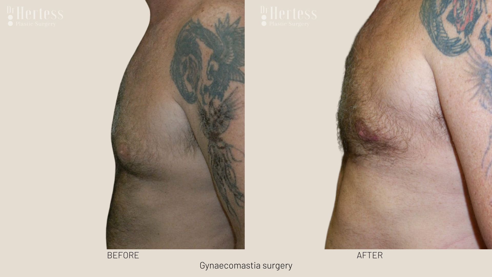 gynecomastia surgery