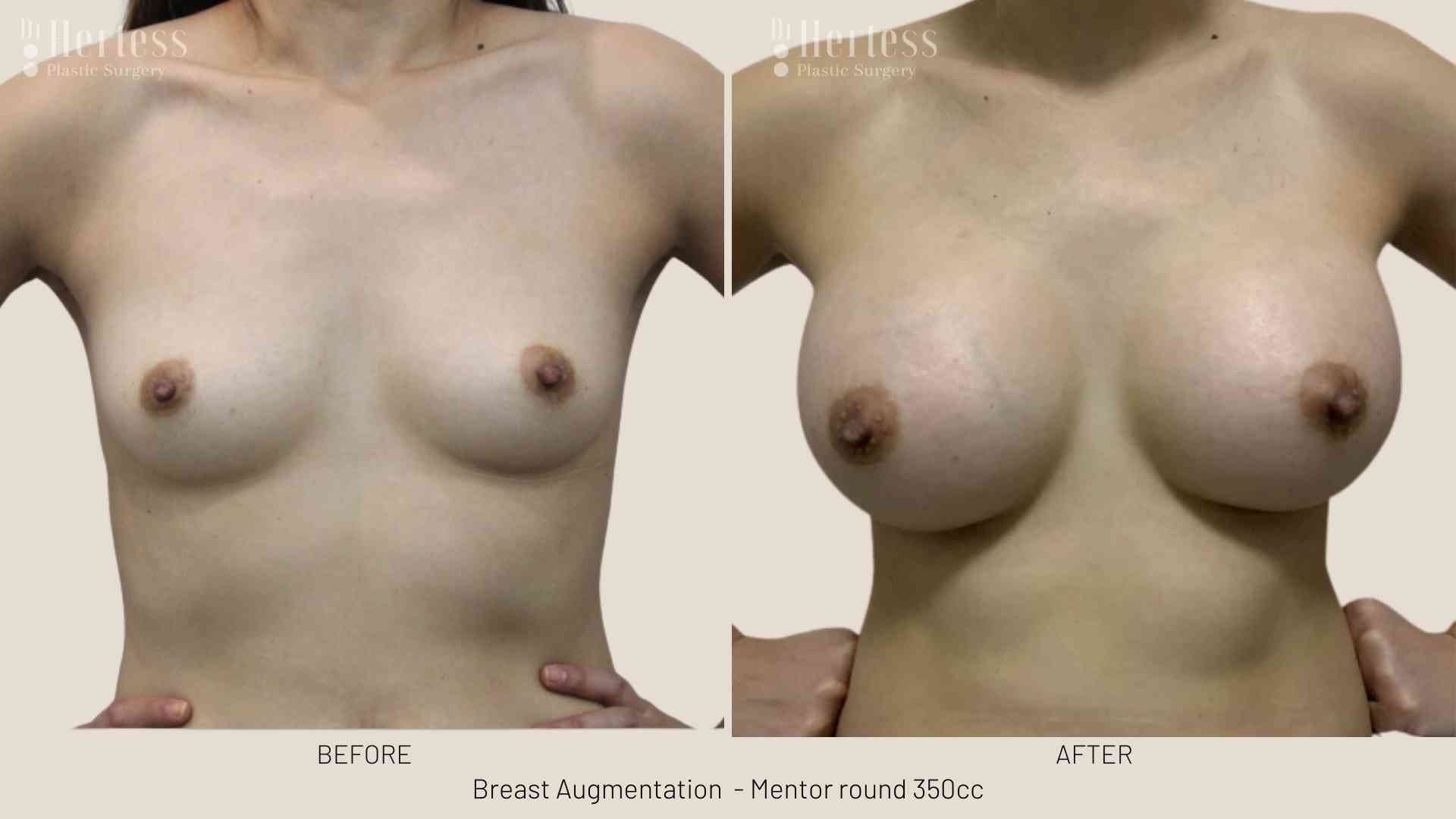 before and after augmentation