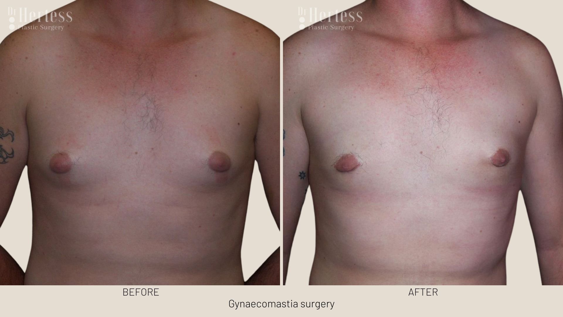 gynecomastia surgery