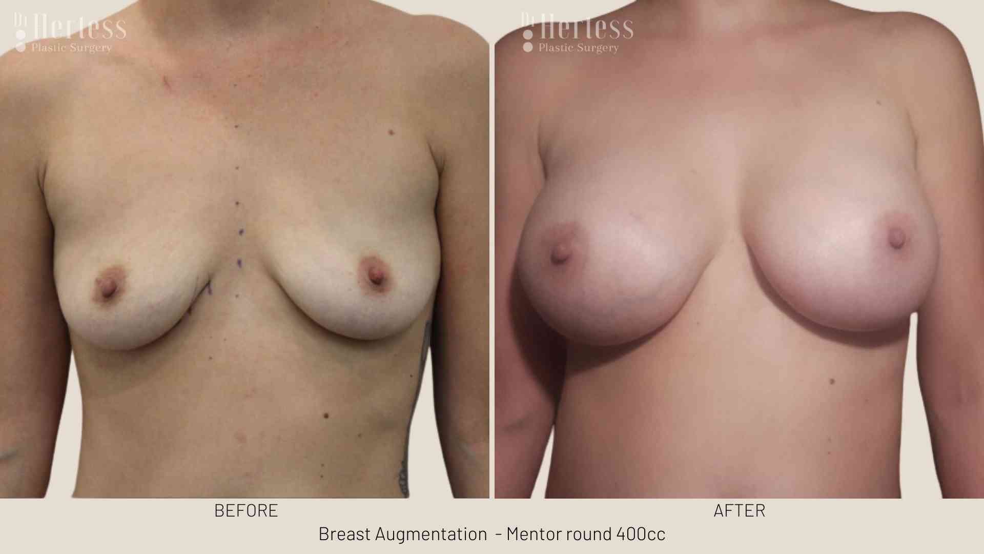 before and after augmentation