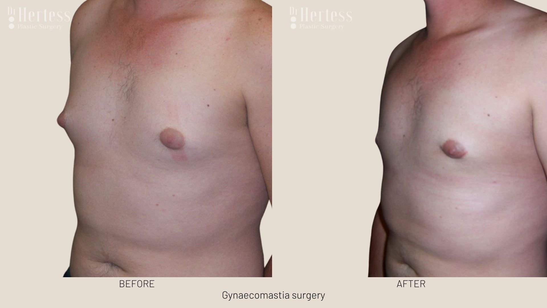 gynecomastia surgery