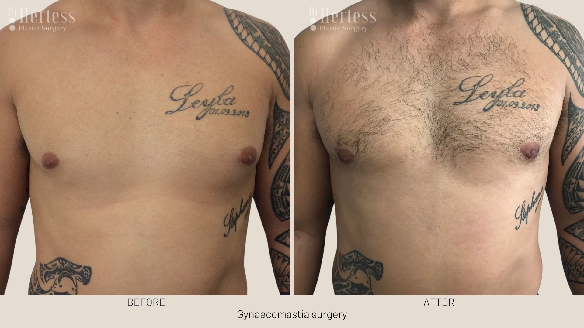 gynecomastia surgery