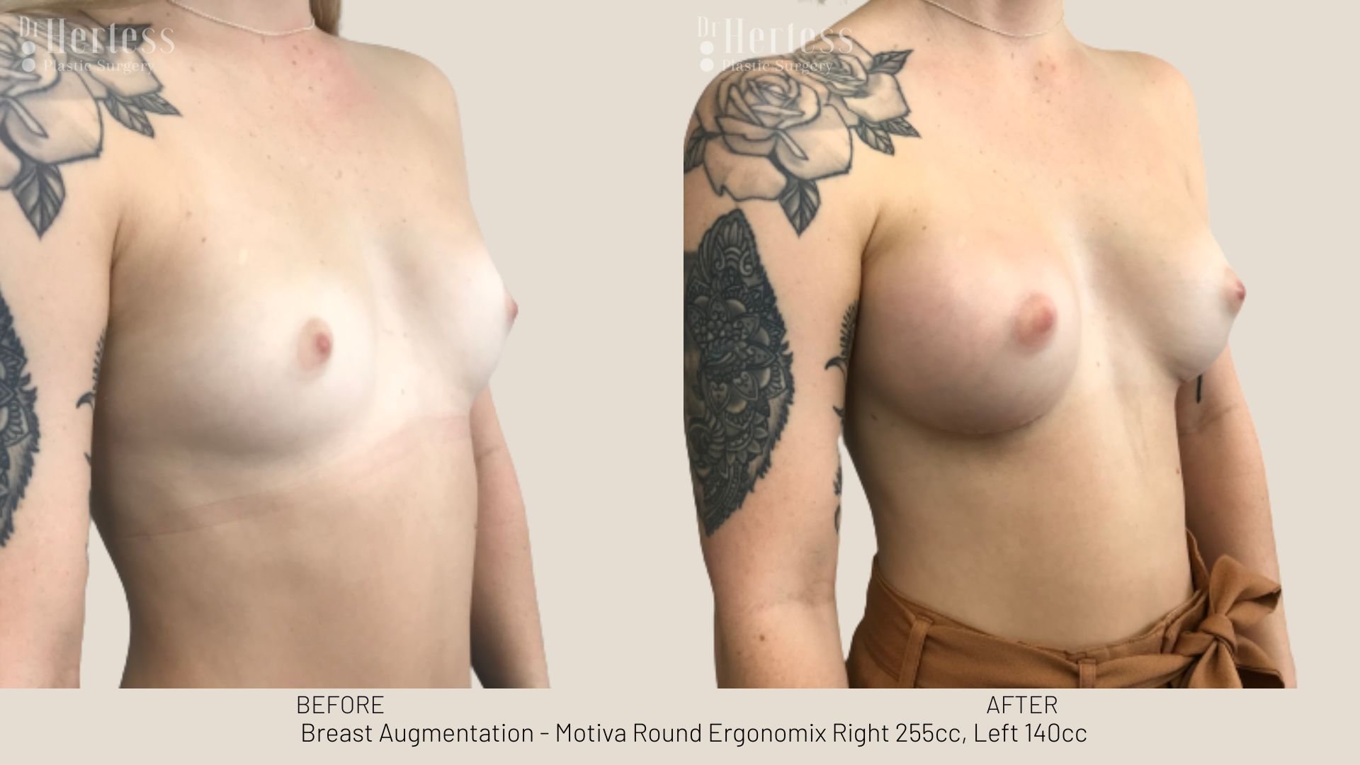 breast enlargement before and after