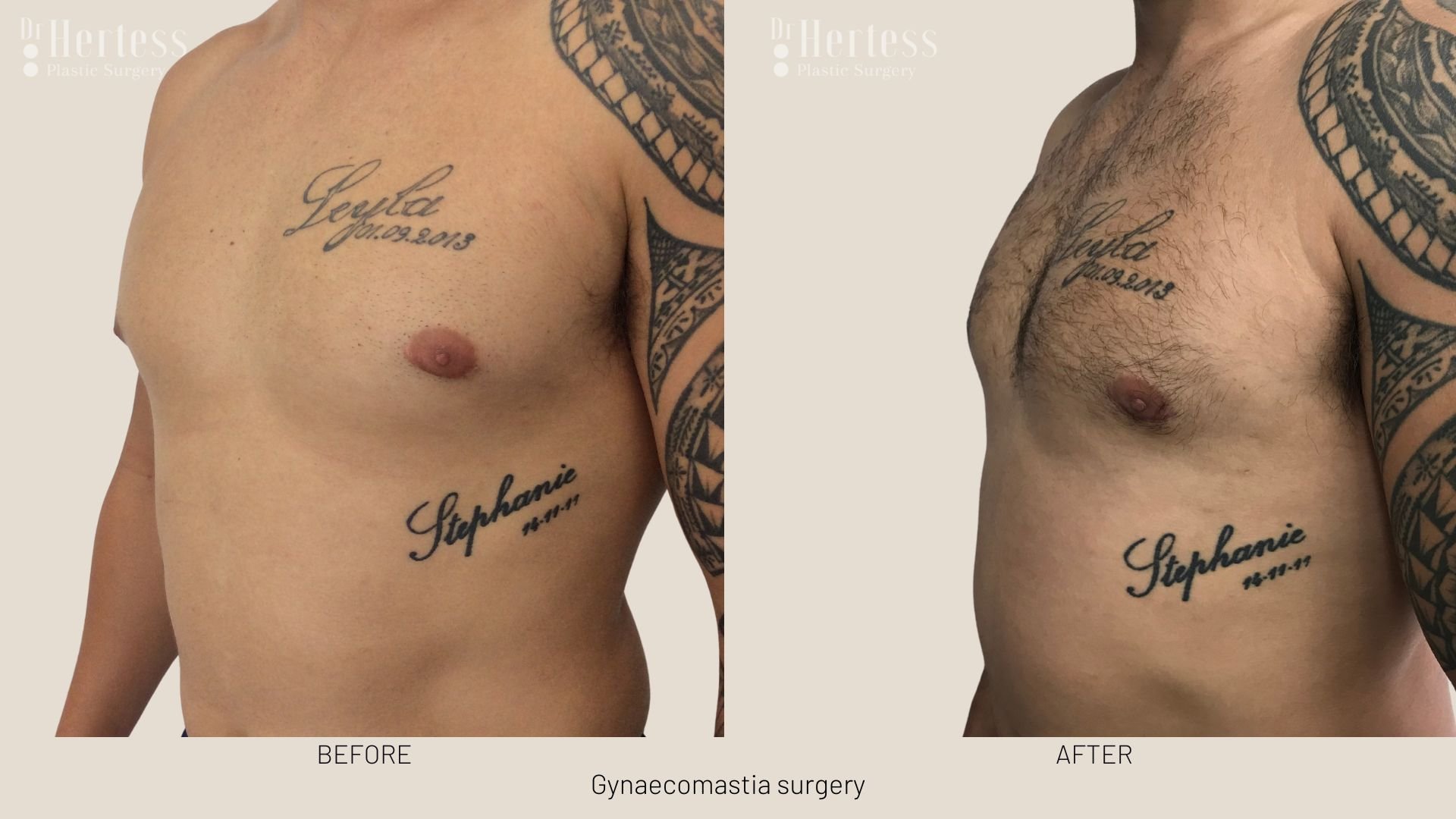 gynecomastia surgery