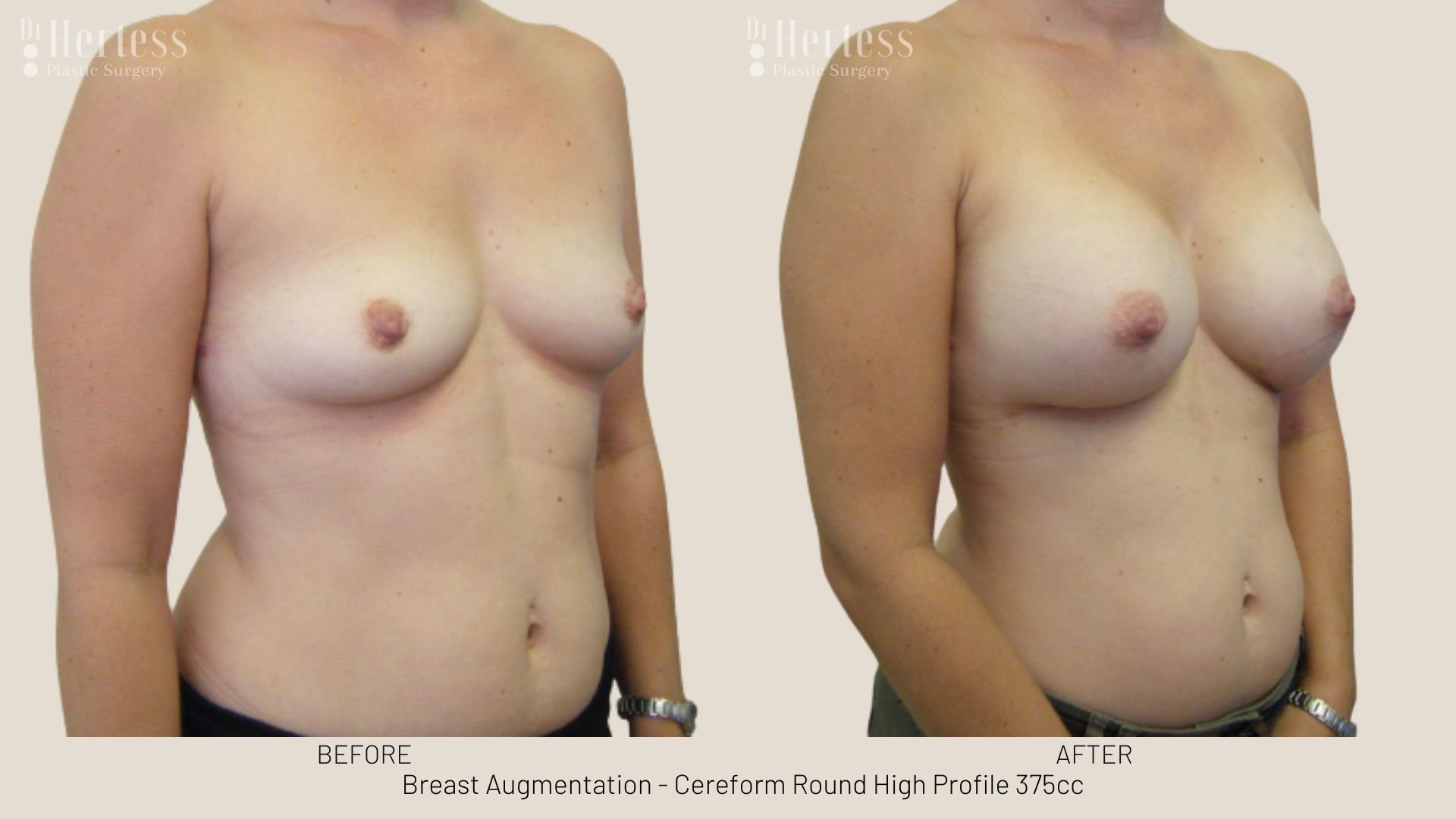 breast enlargement before and after