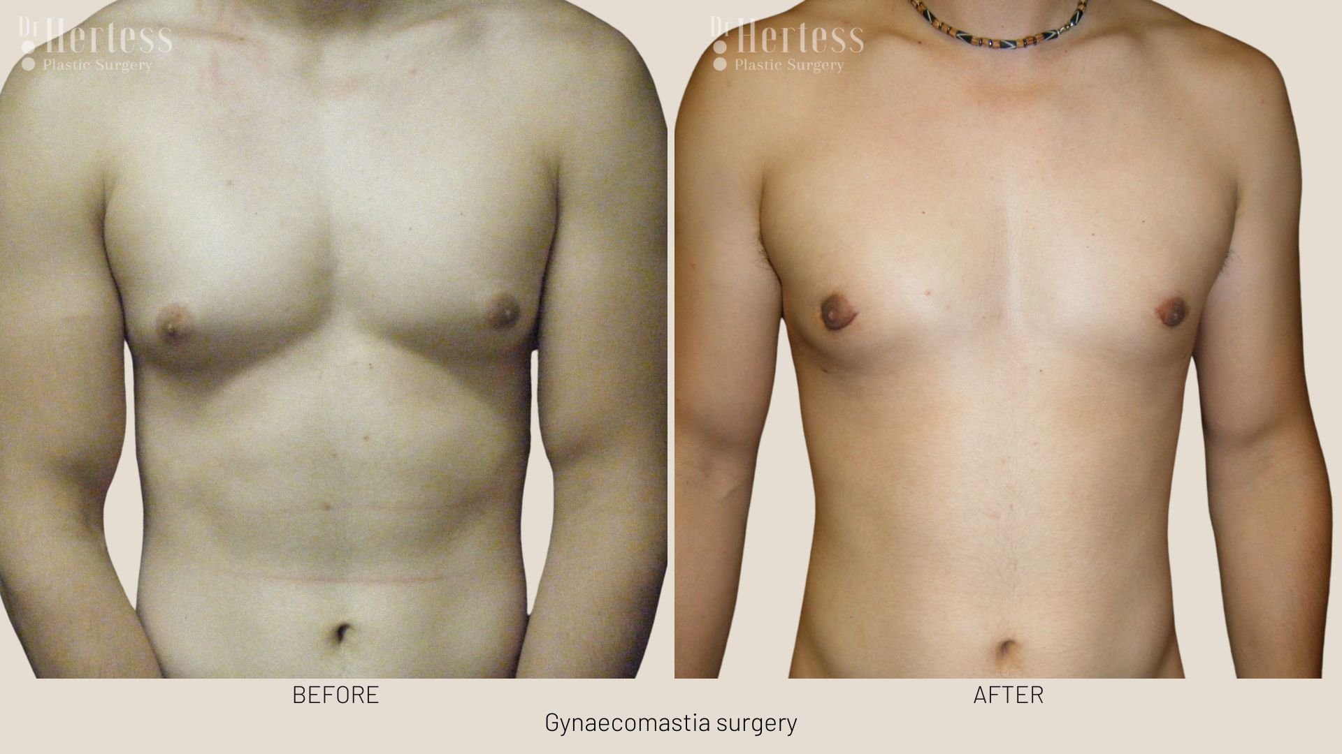 gynecomastia surgery