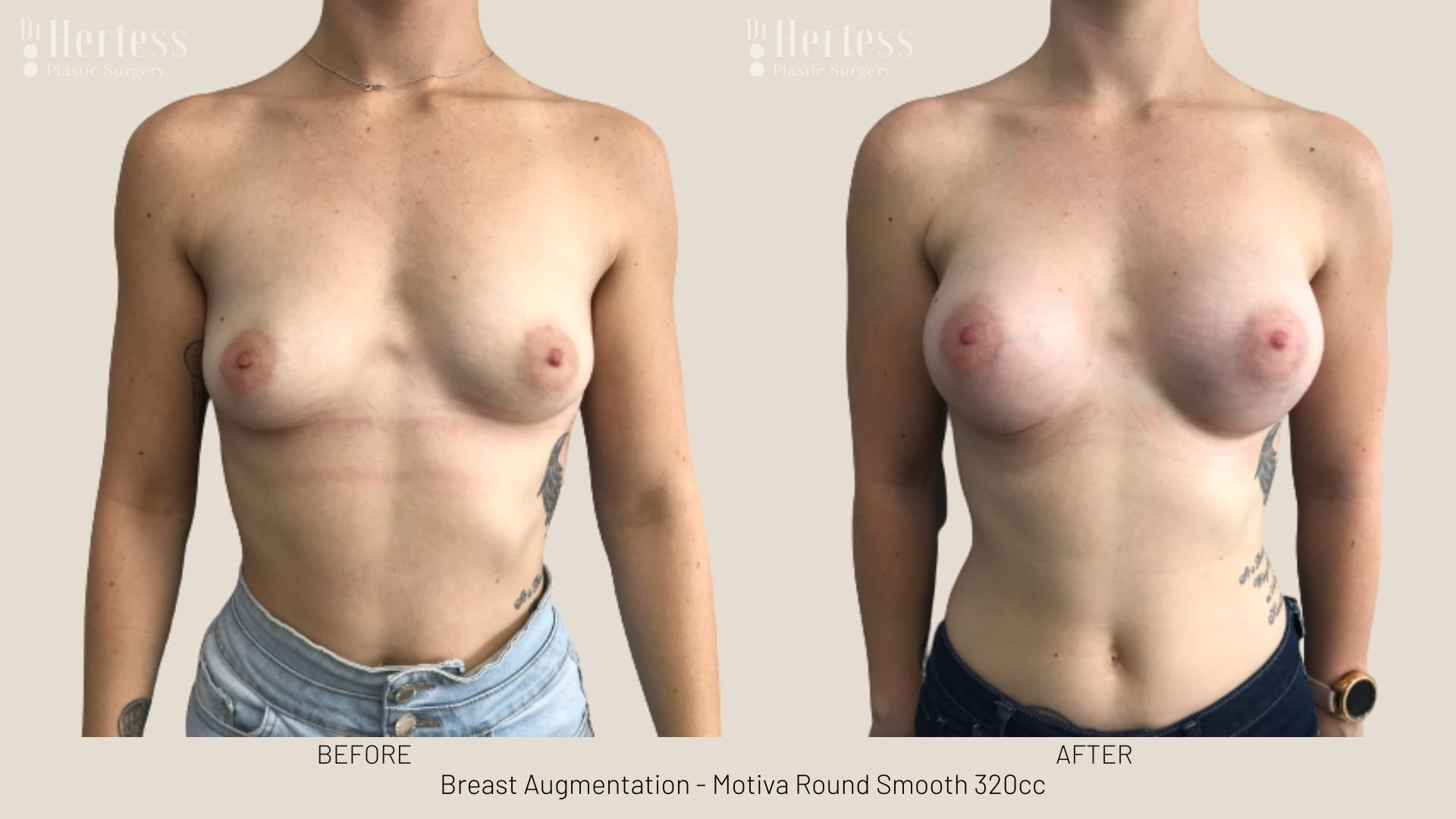 breast enlargement before and after