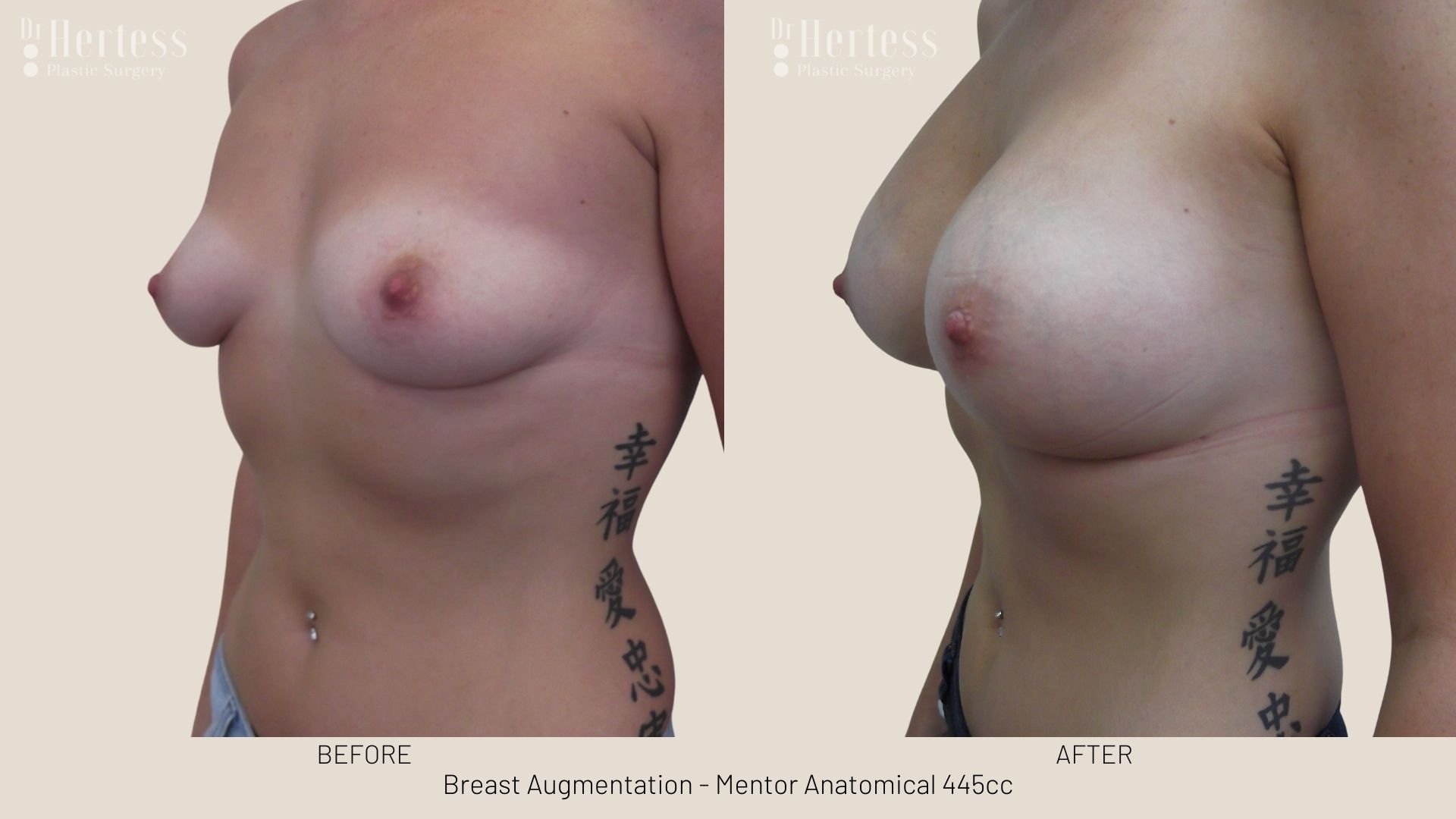 breast aug before and after