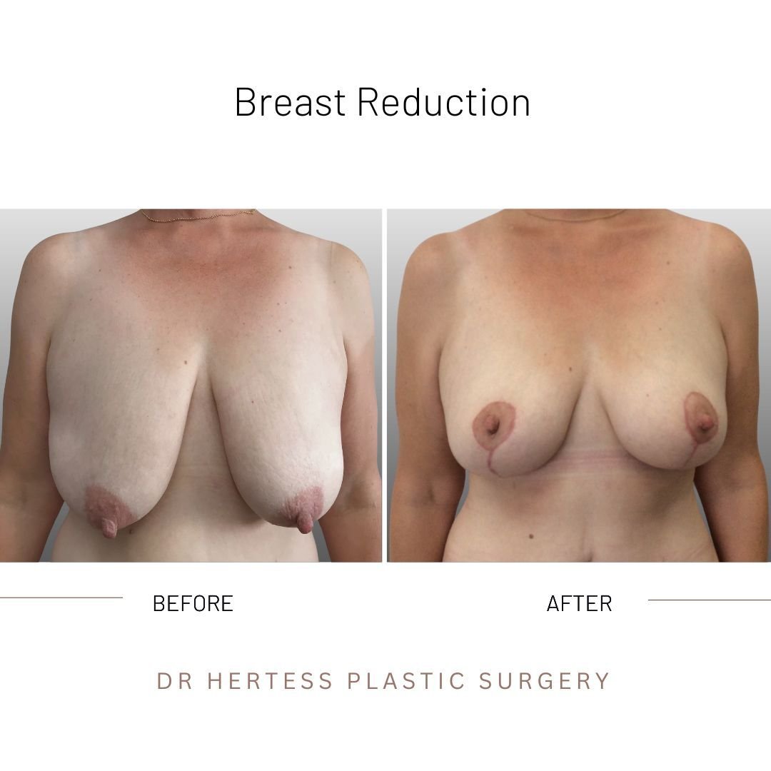 before and after breast reduction