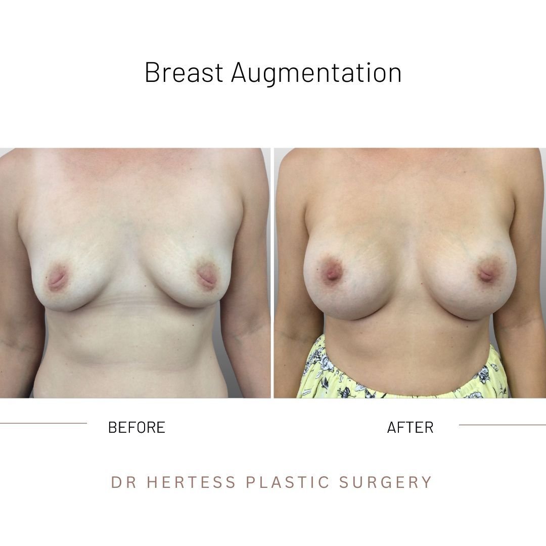 breast enhancement