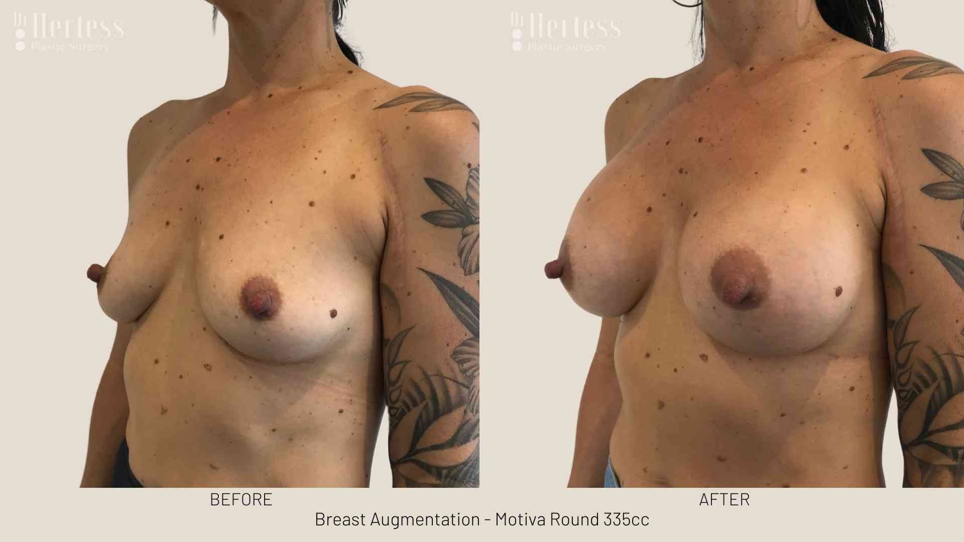 before and after augmentation
