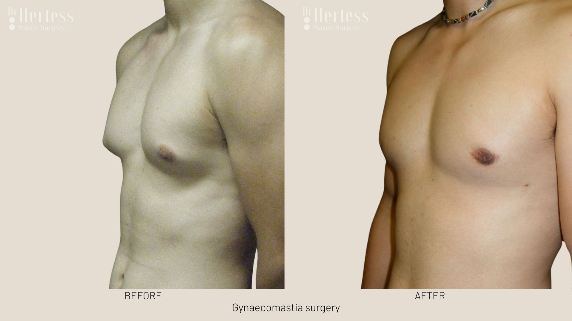 gynecomastia surgery