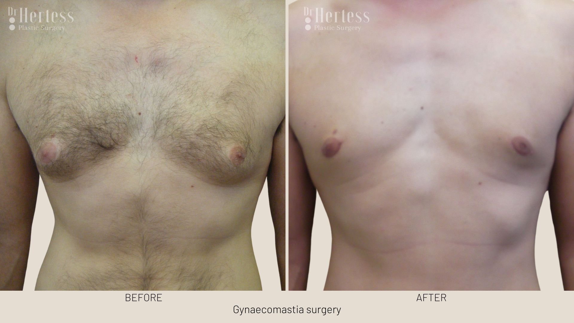 gynaecomastia