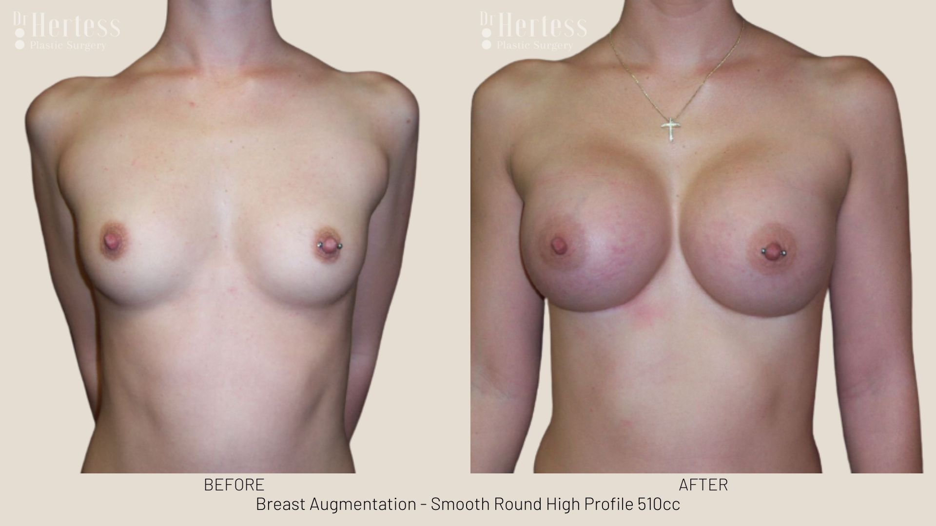 breast enlargement before and after