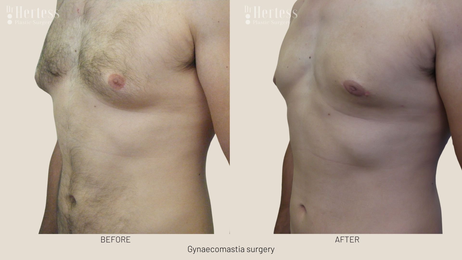 gynaecomastia