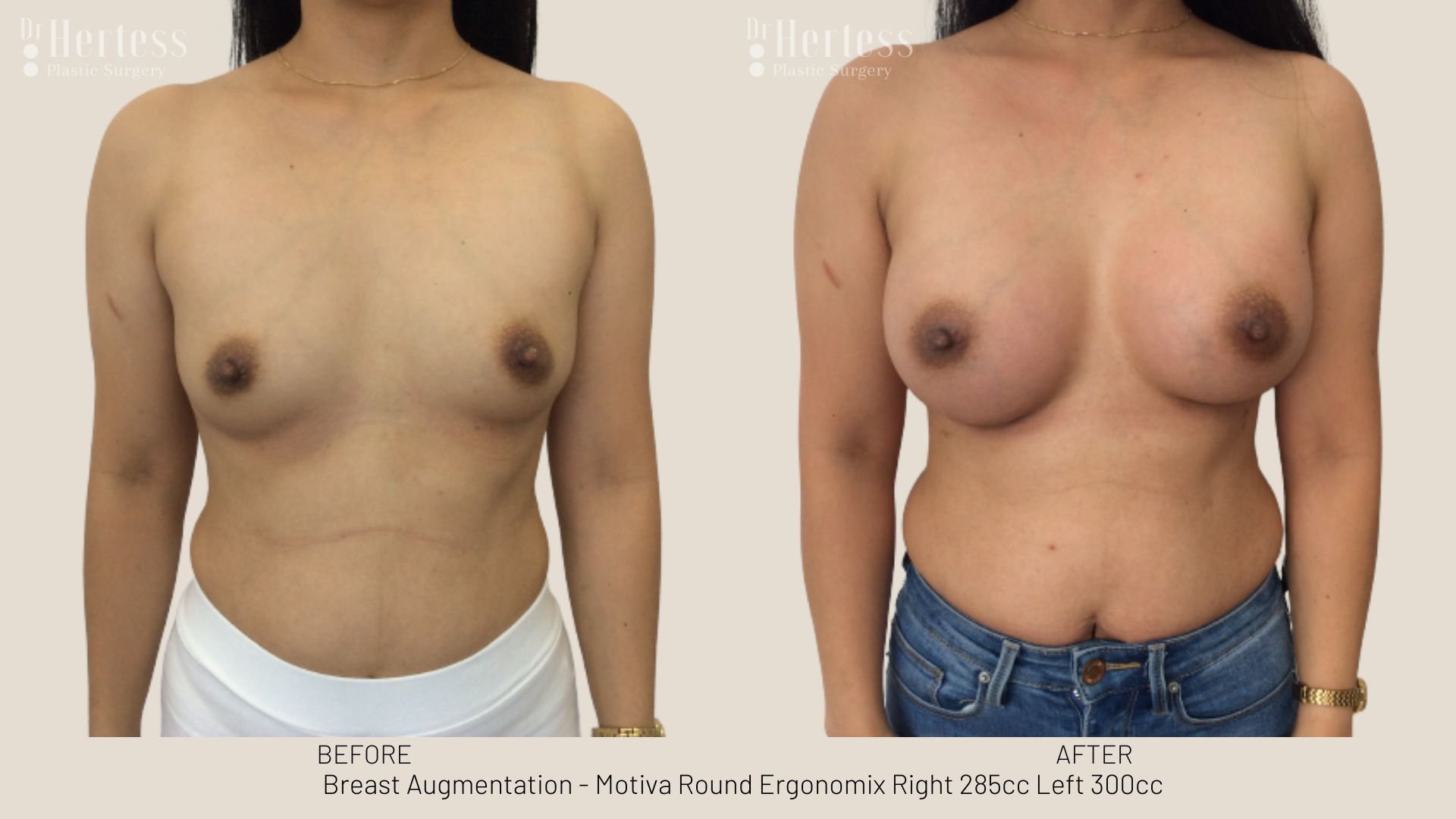 breast enlargement before and after