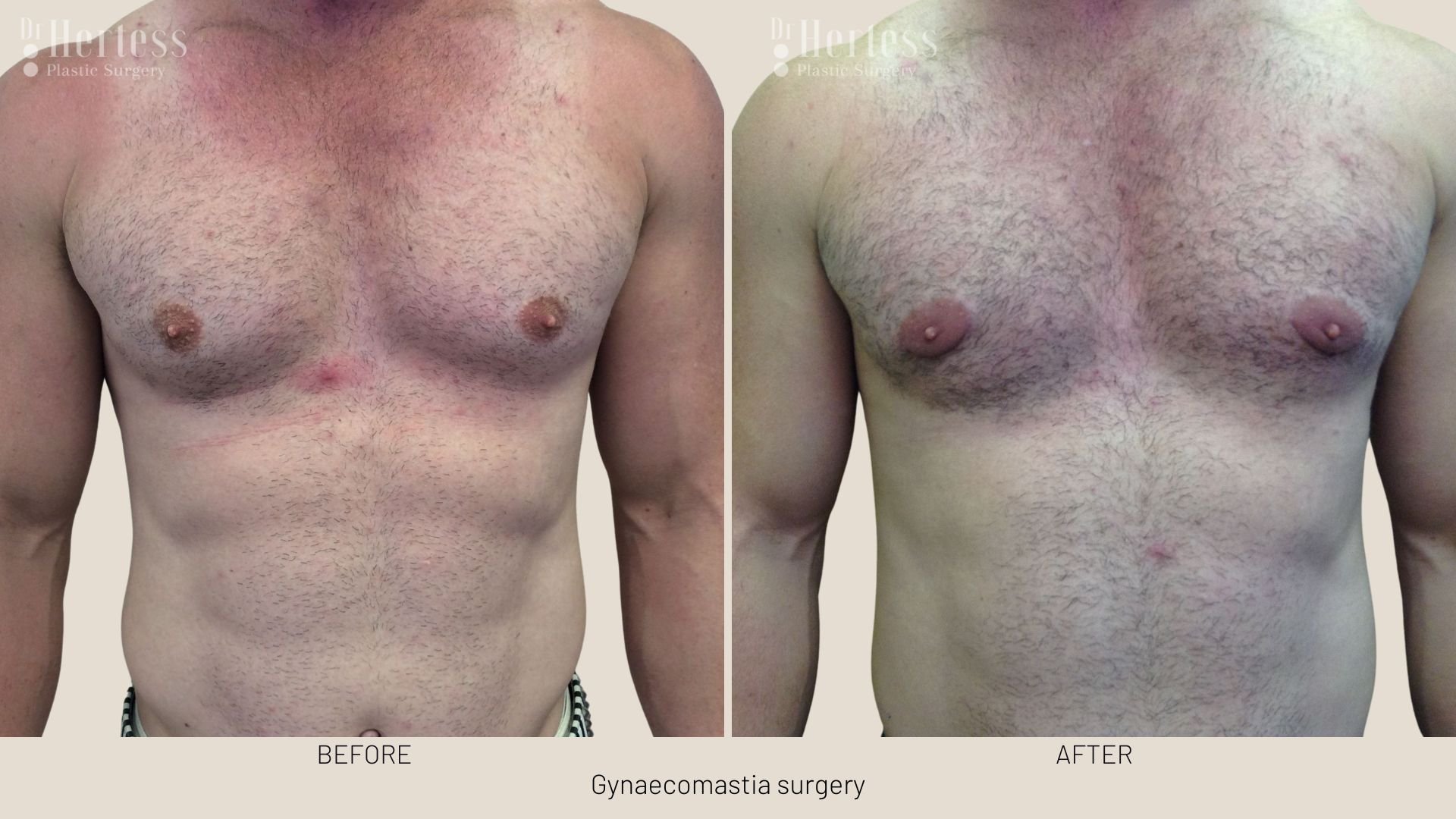 gynaecomastia