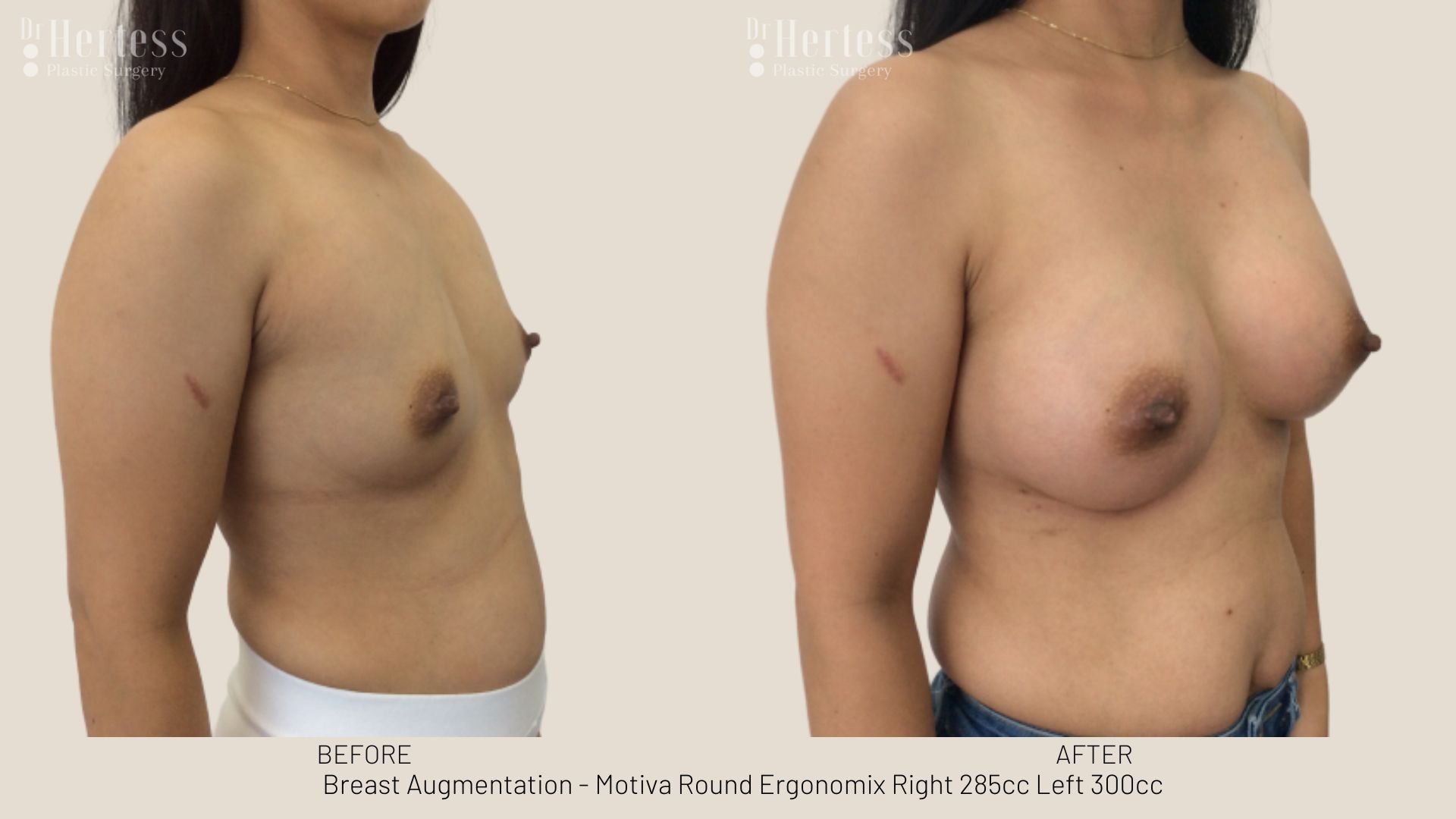 breast enlargement before and after