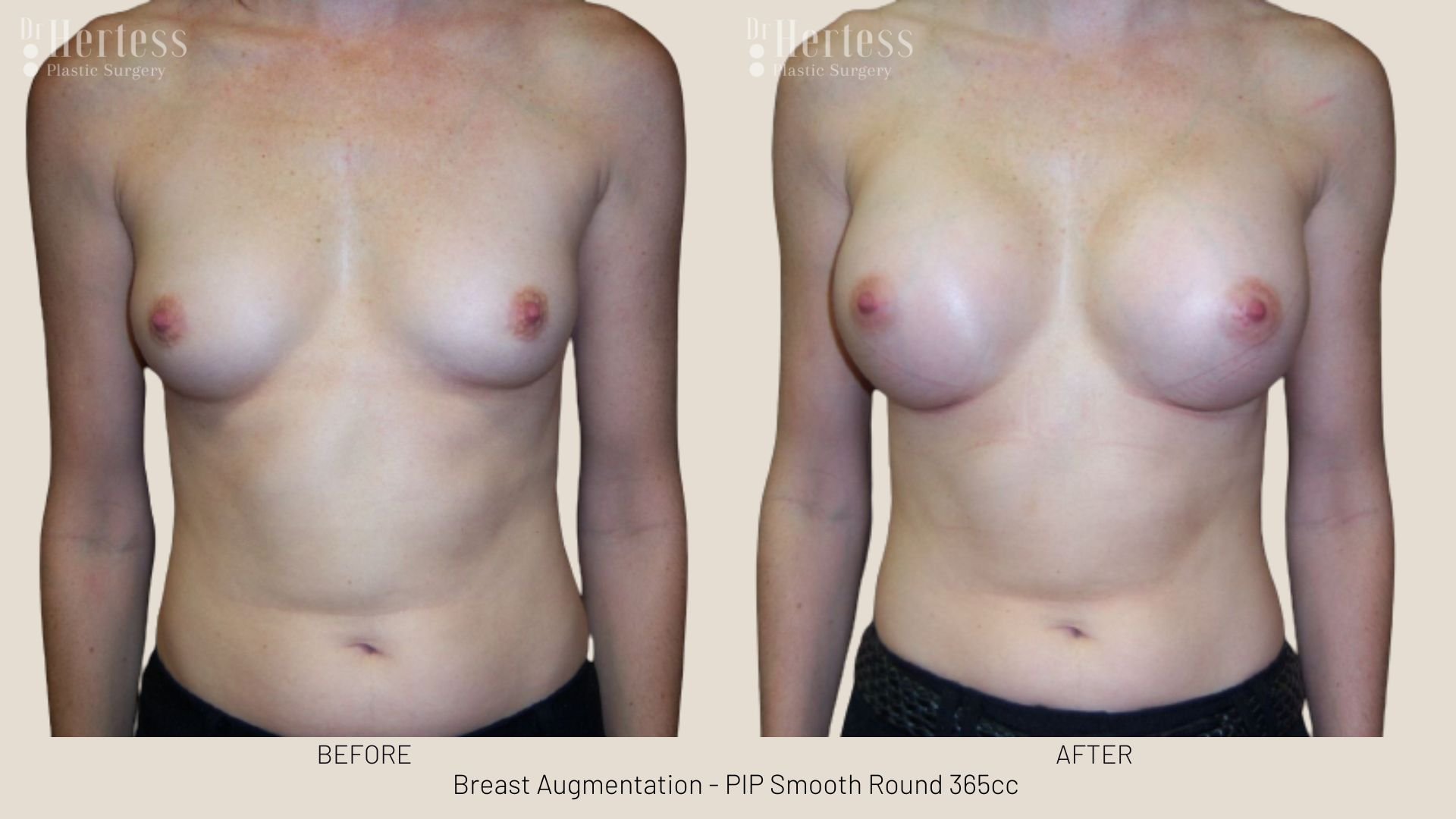 breast implant photos