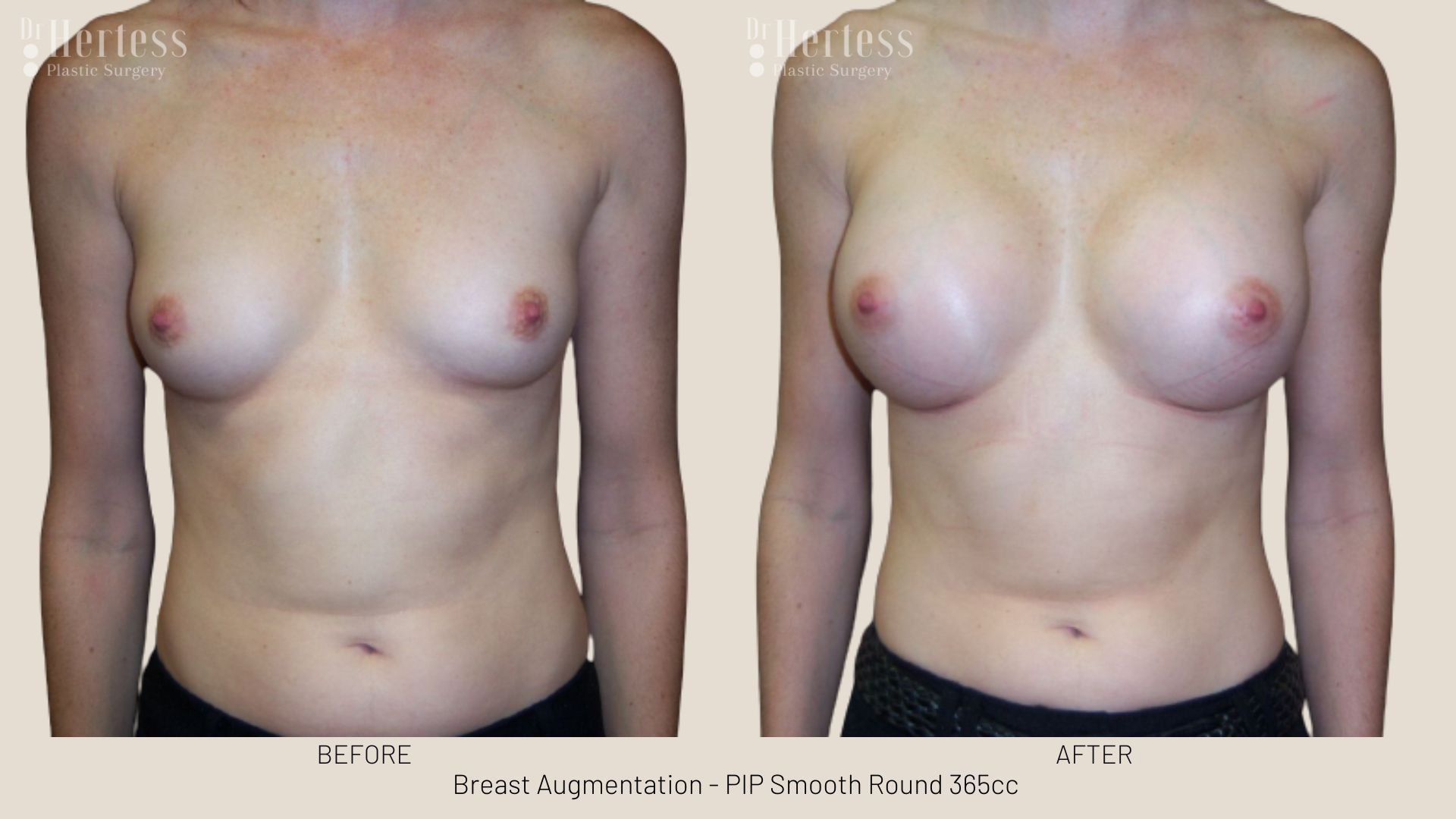 breast augmentation before and after