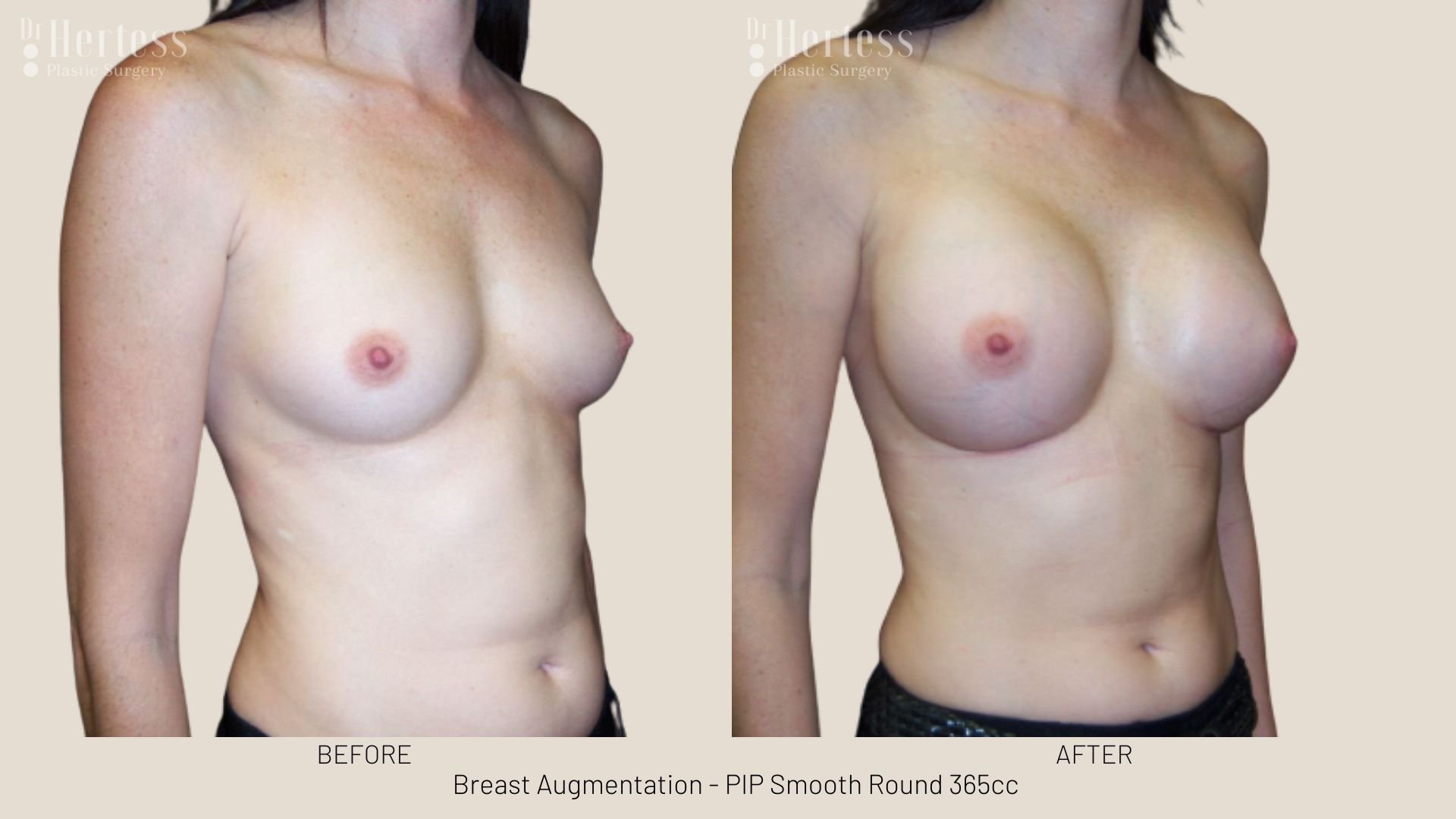 breast augmentation before and after