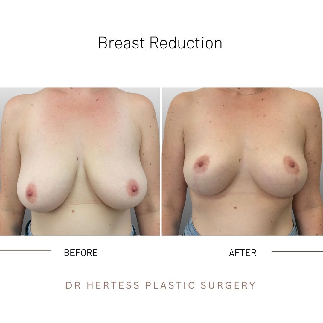before and after breast reduction