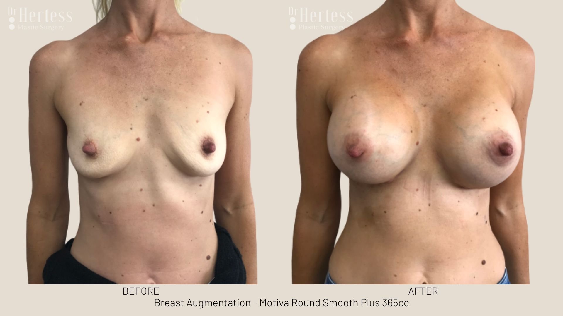 breast augmentation before and after