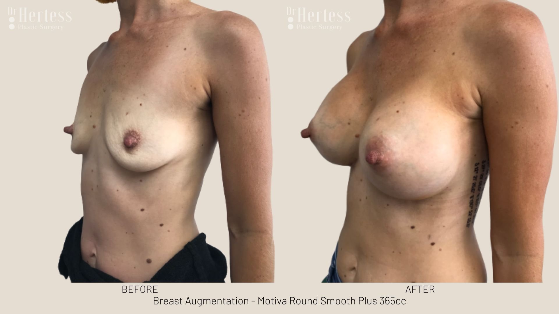 breast augmentation before and after