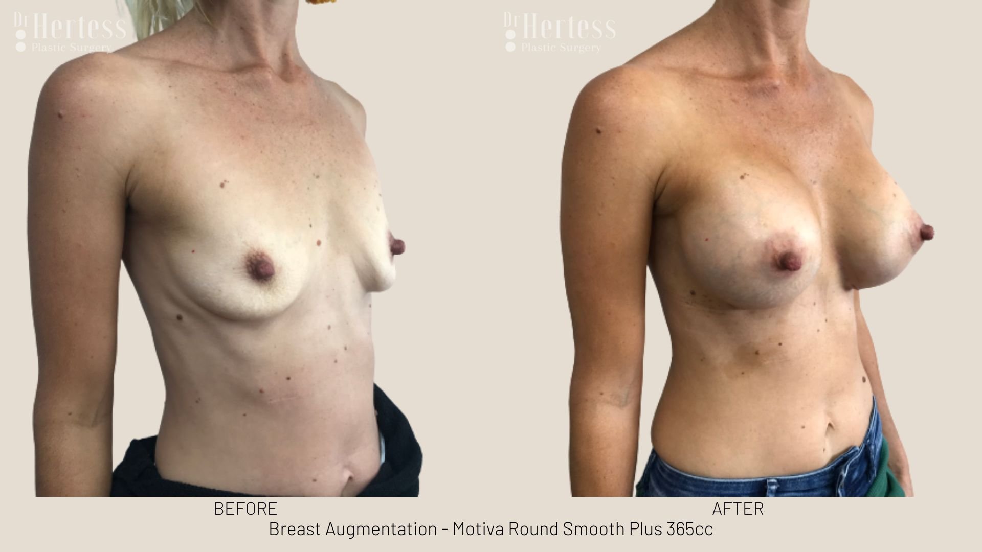 breast augmentation before and after