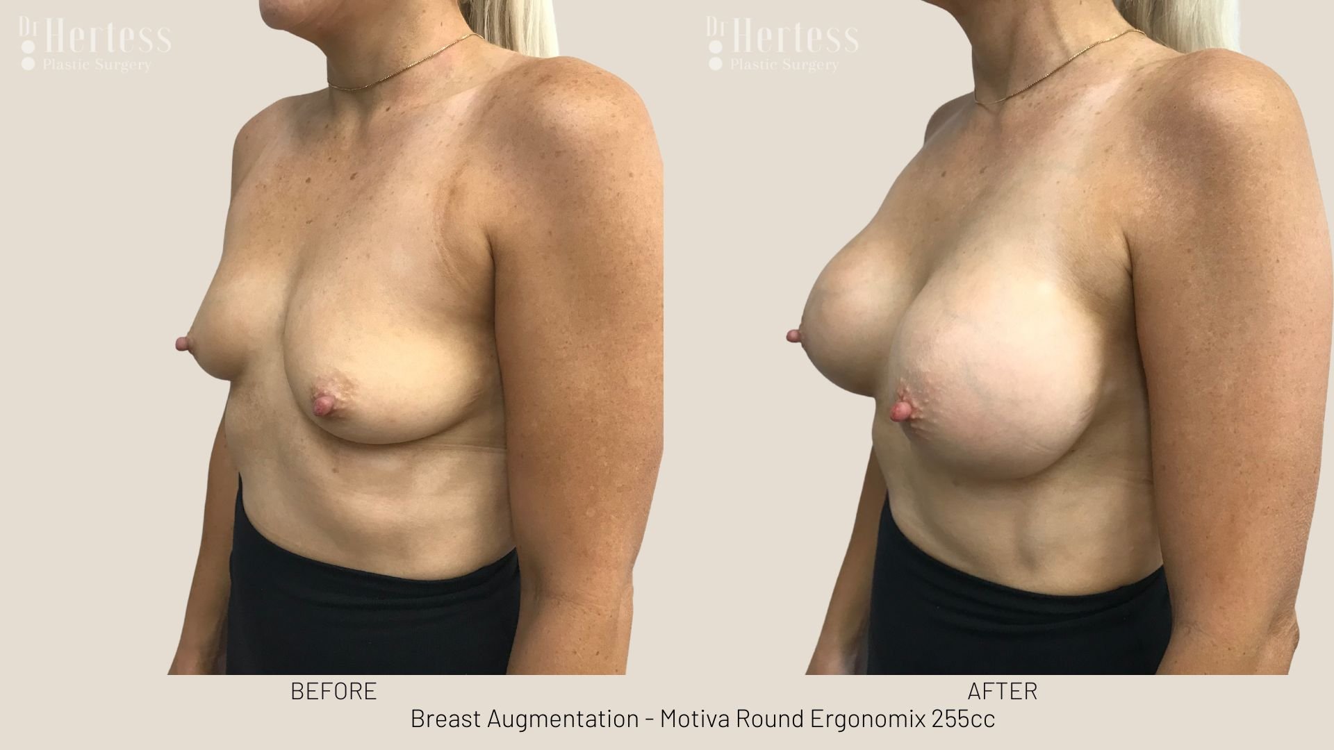 breast implant photos