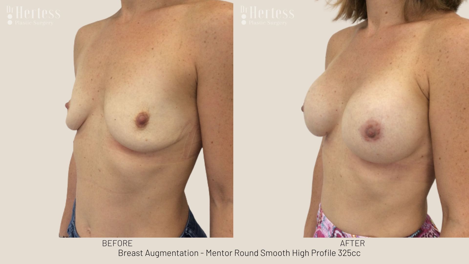 breast enlargement before and after