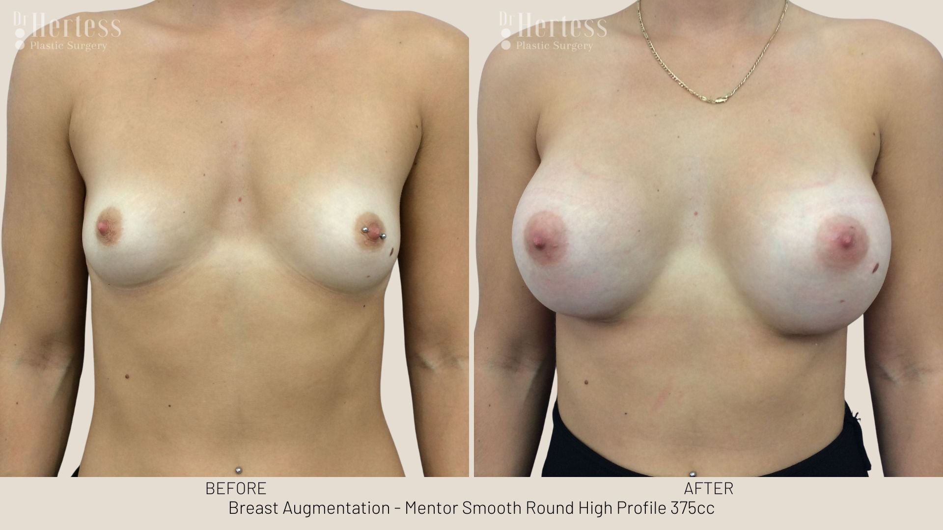 breast enlargement before and after