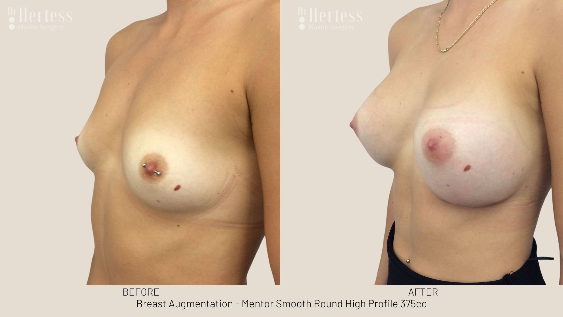 breast enlargement before and after