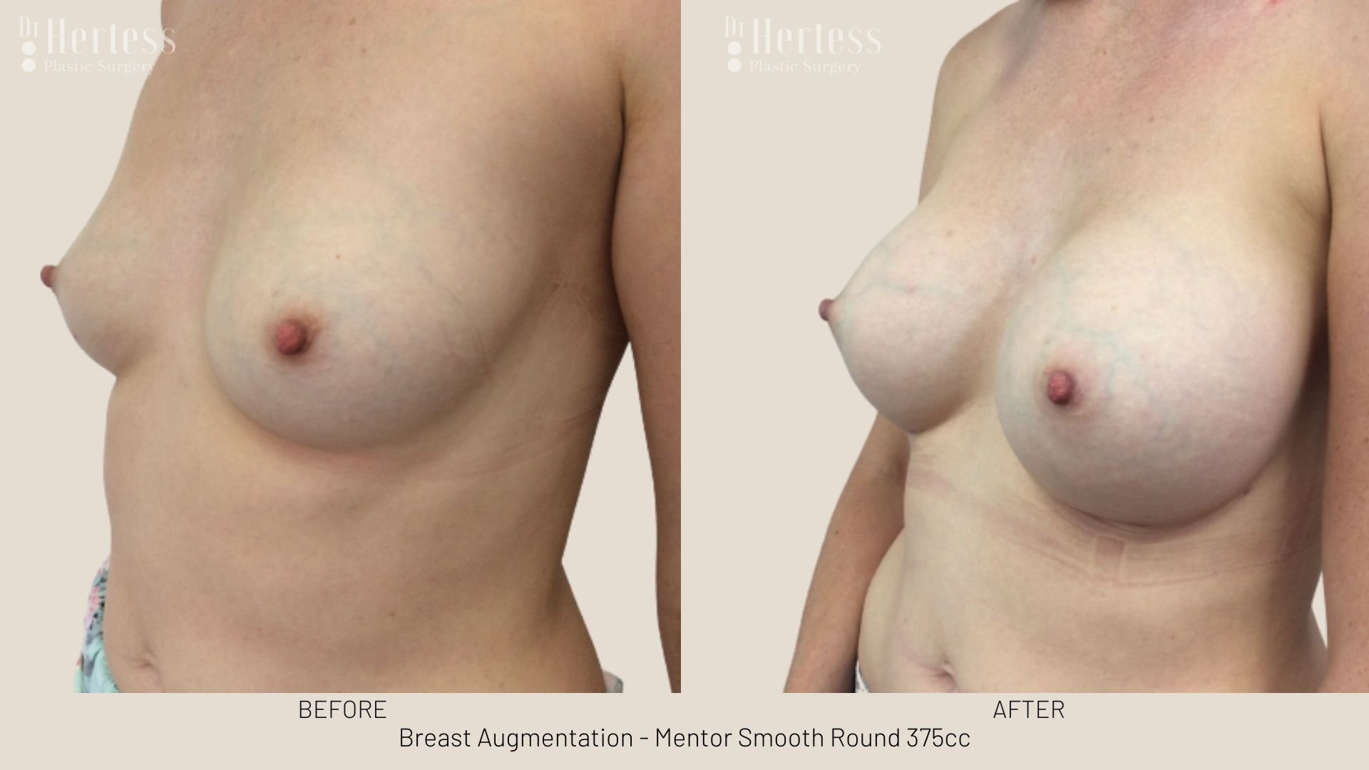 breast enlargement before and after