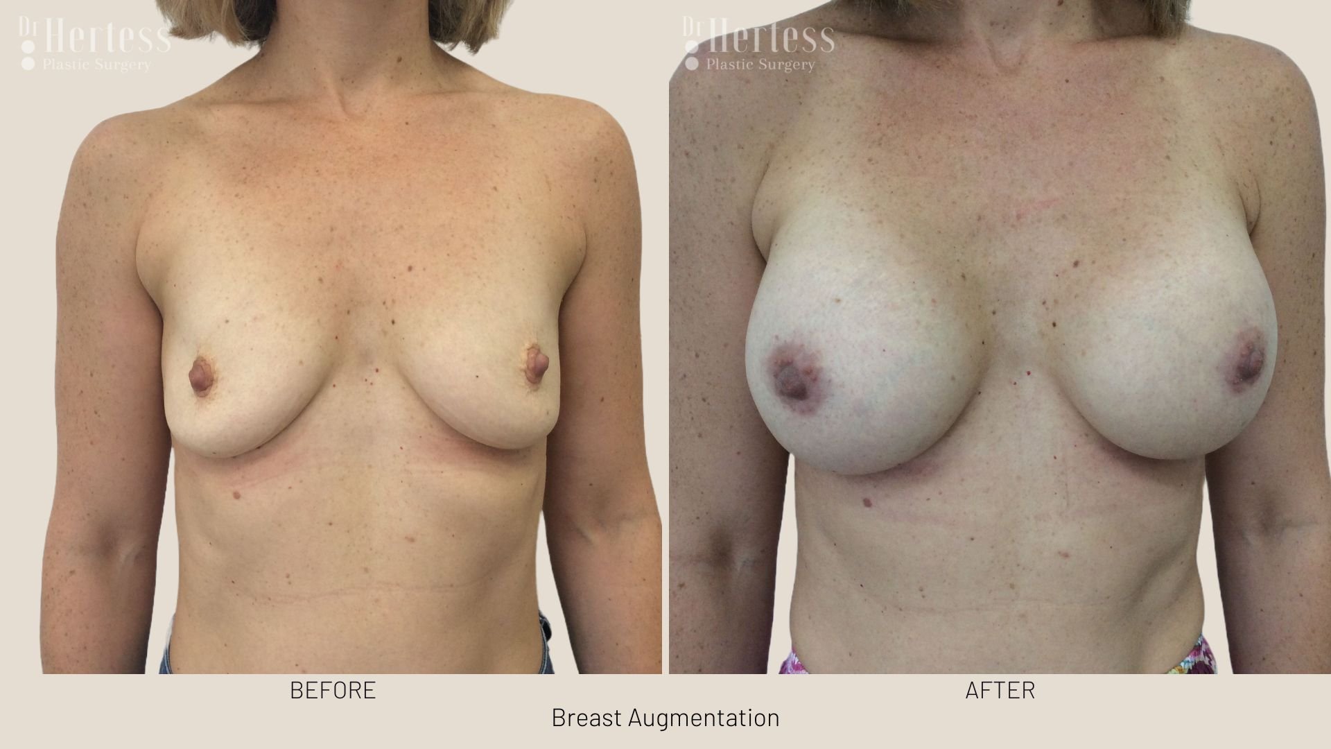 breast enlargement before and after