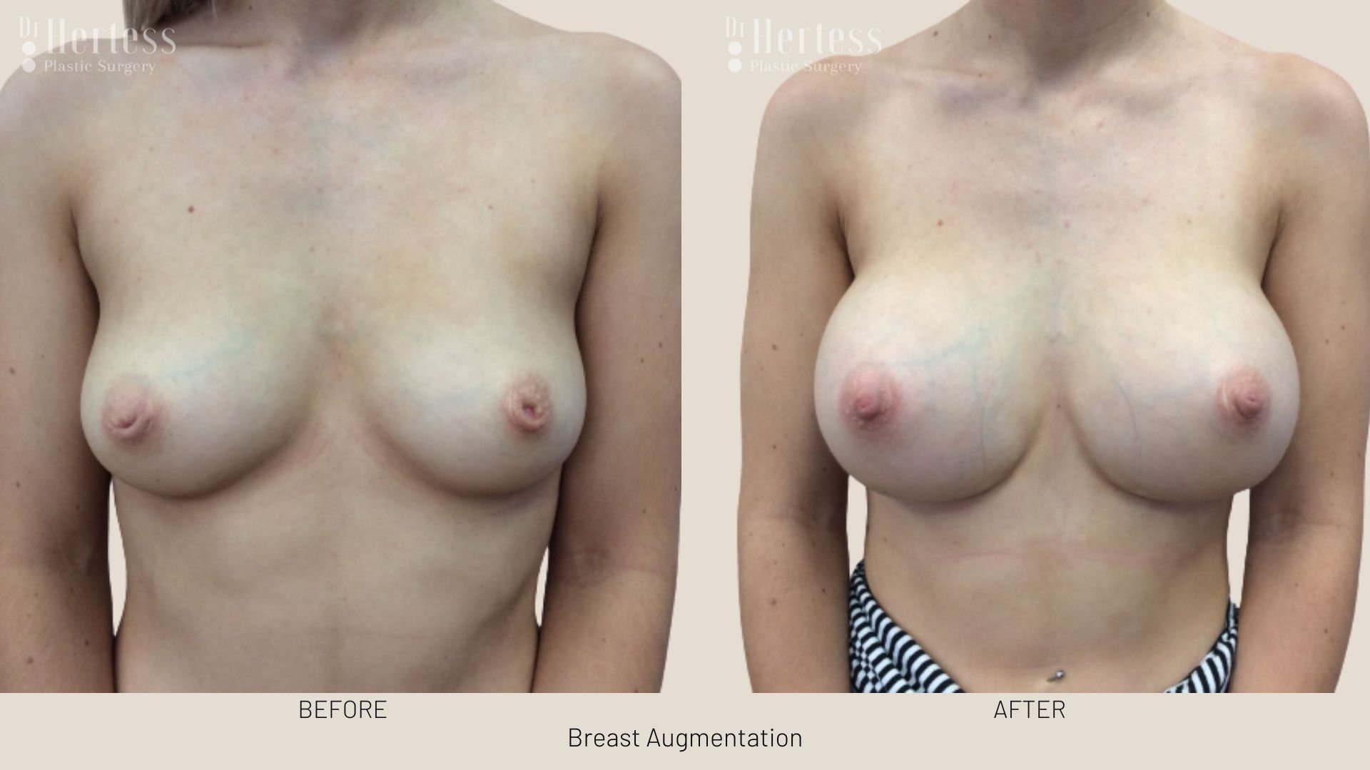 breast aug before and after