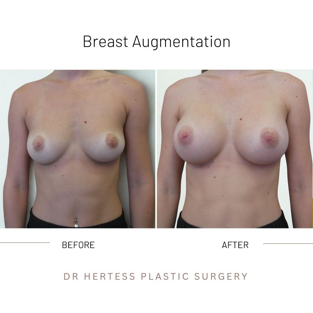 breast enhancement