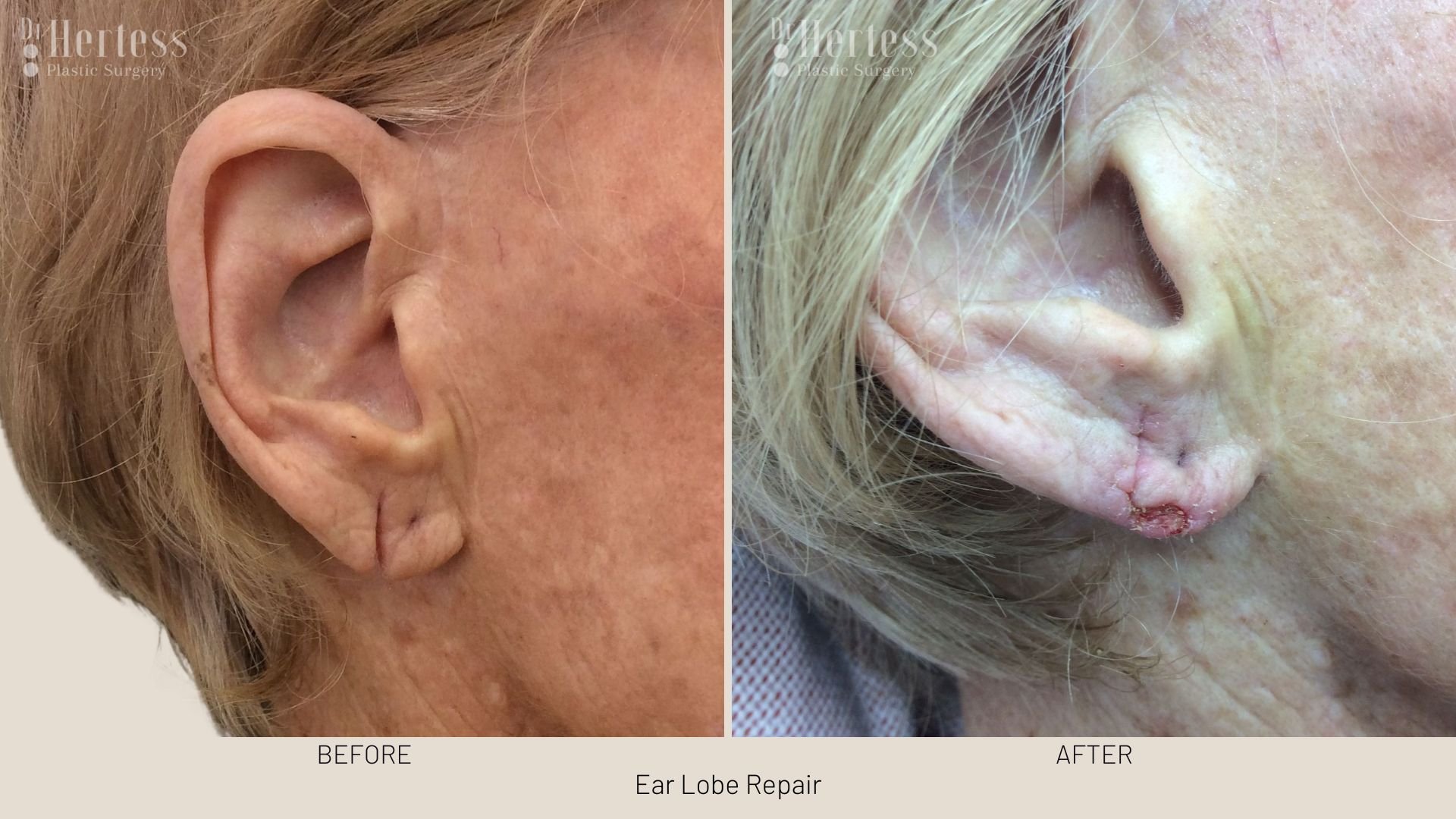 earlobe surgery