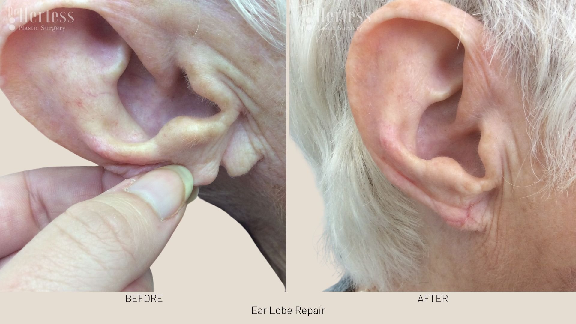 earlobe surgery