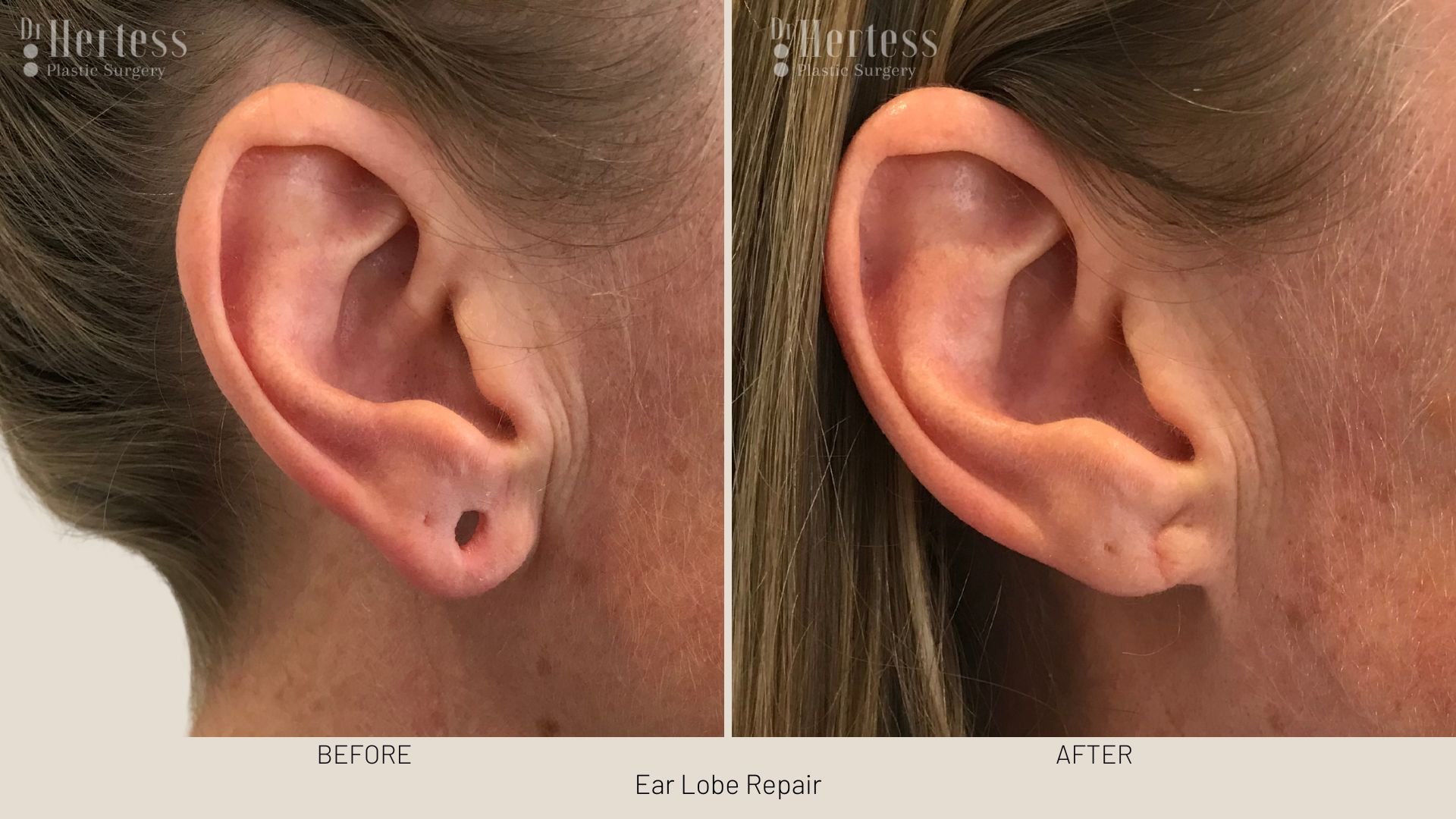 earlobe surgery