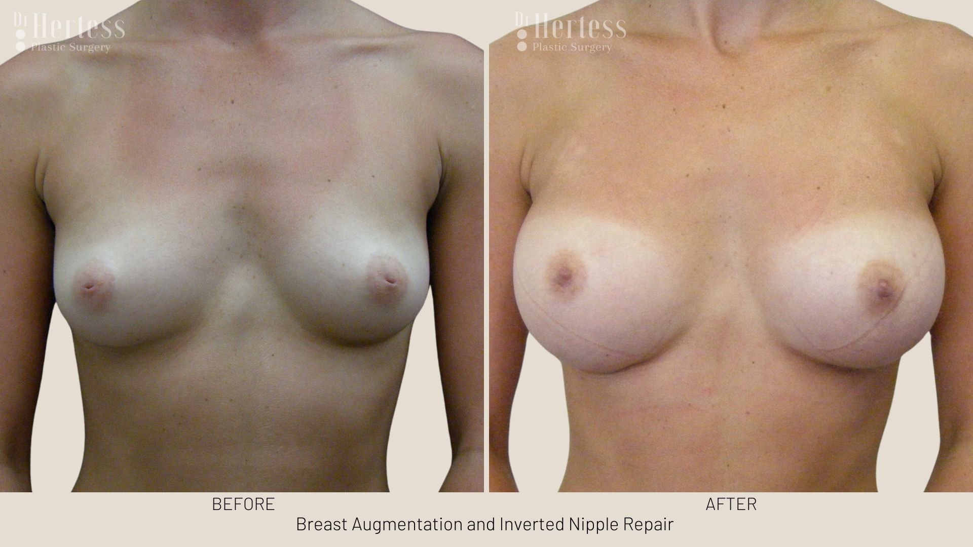 inverted nipple correction