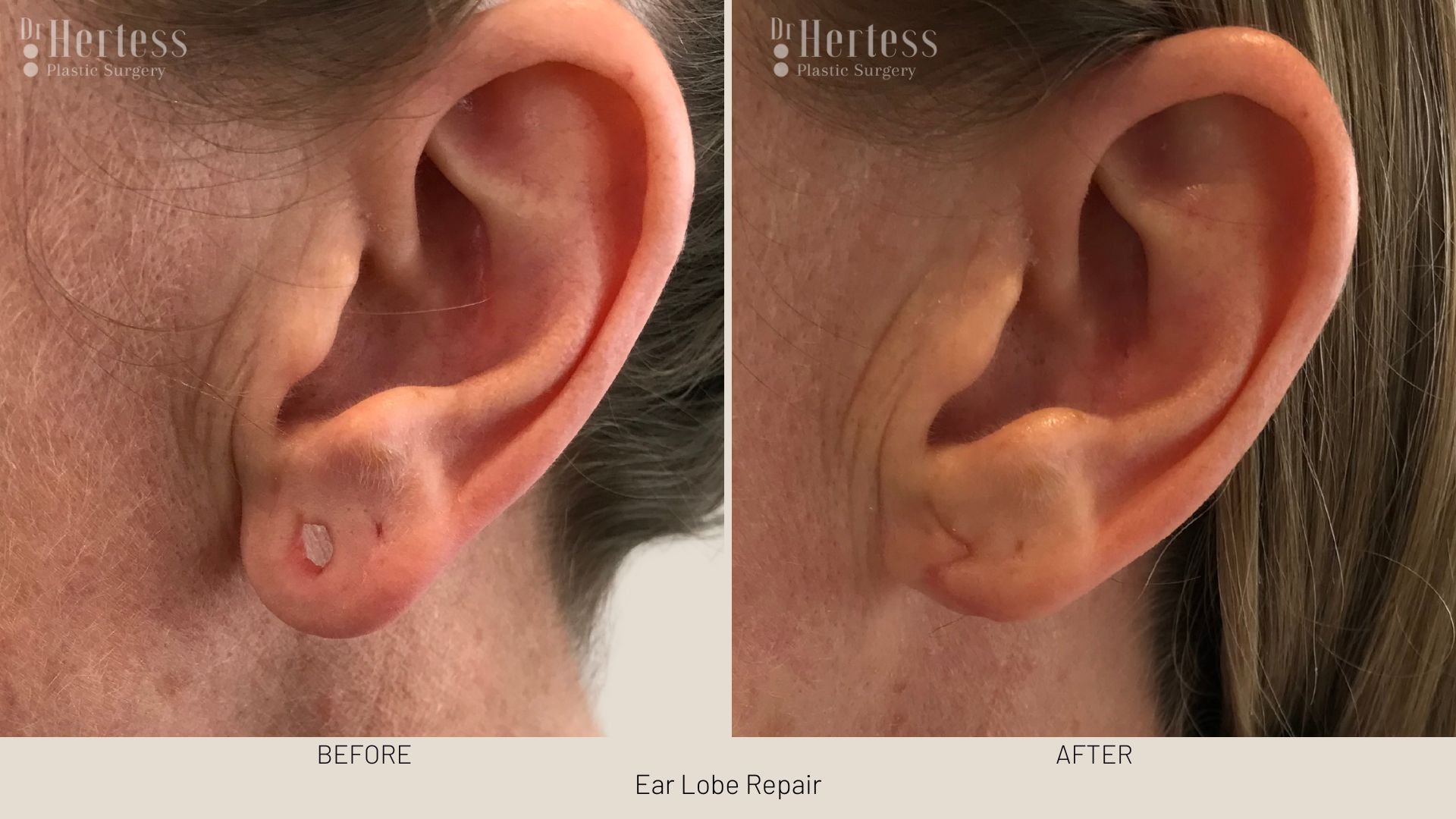 earlobe surgery