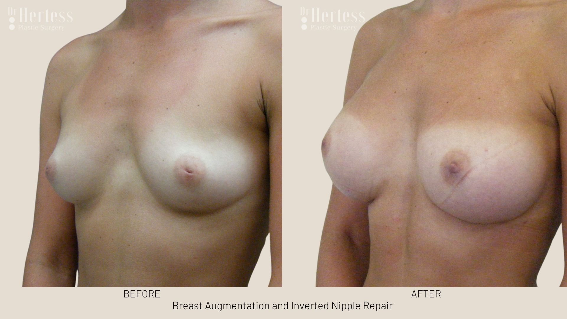 inverted nipple correction