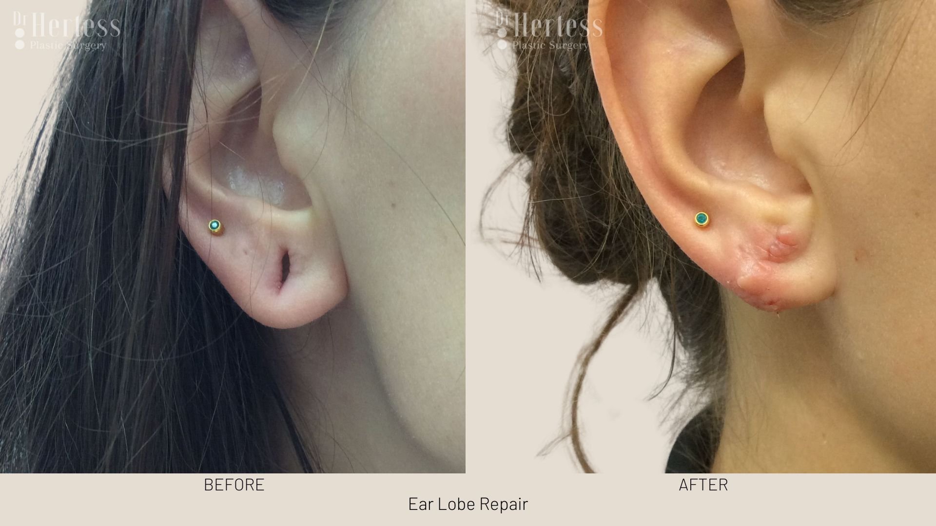 earlobe surgery