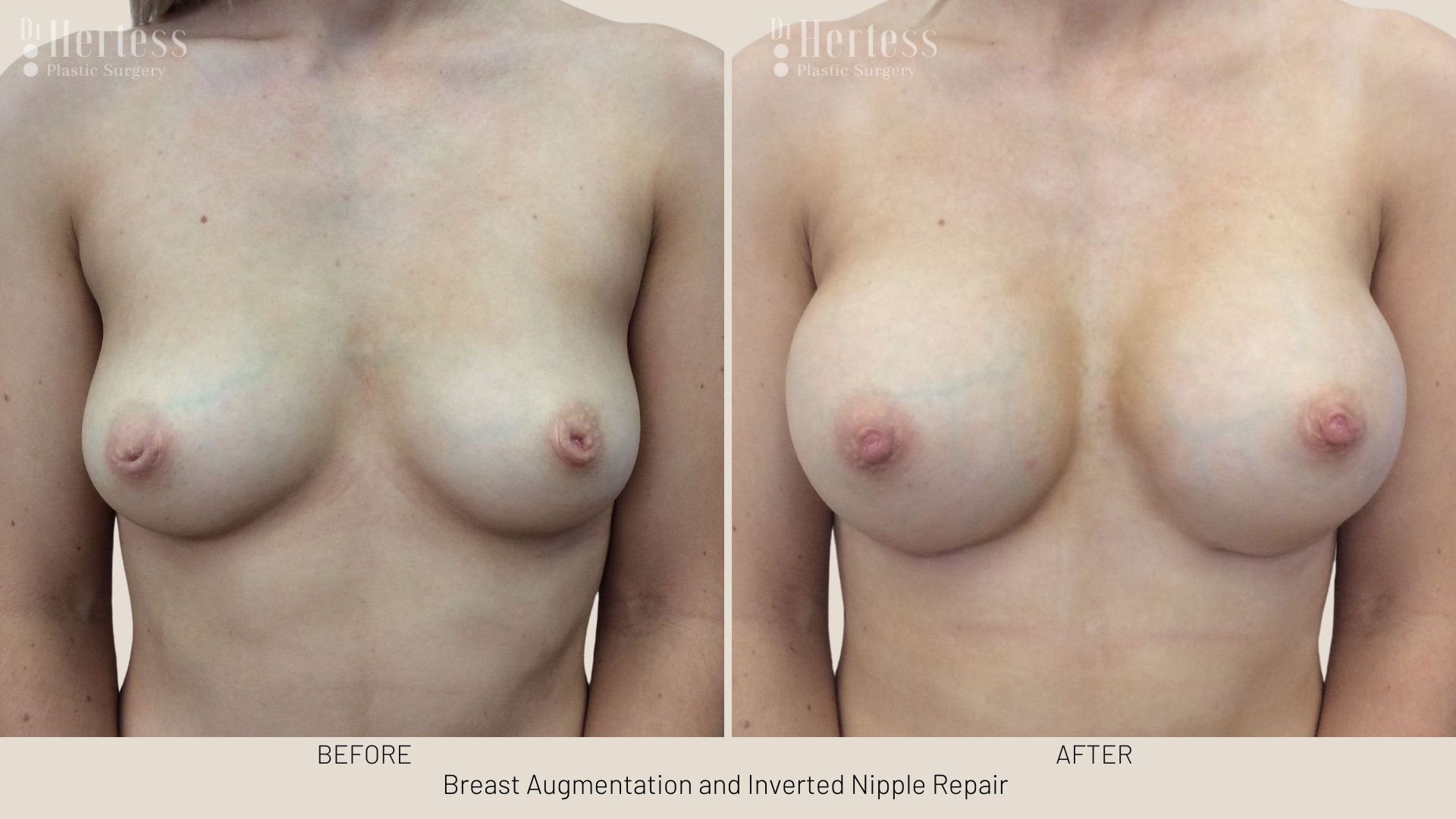 inverted nipple correction