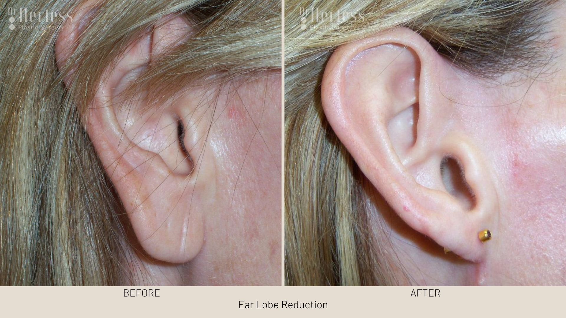 earlobe surgery