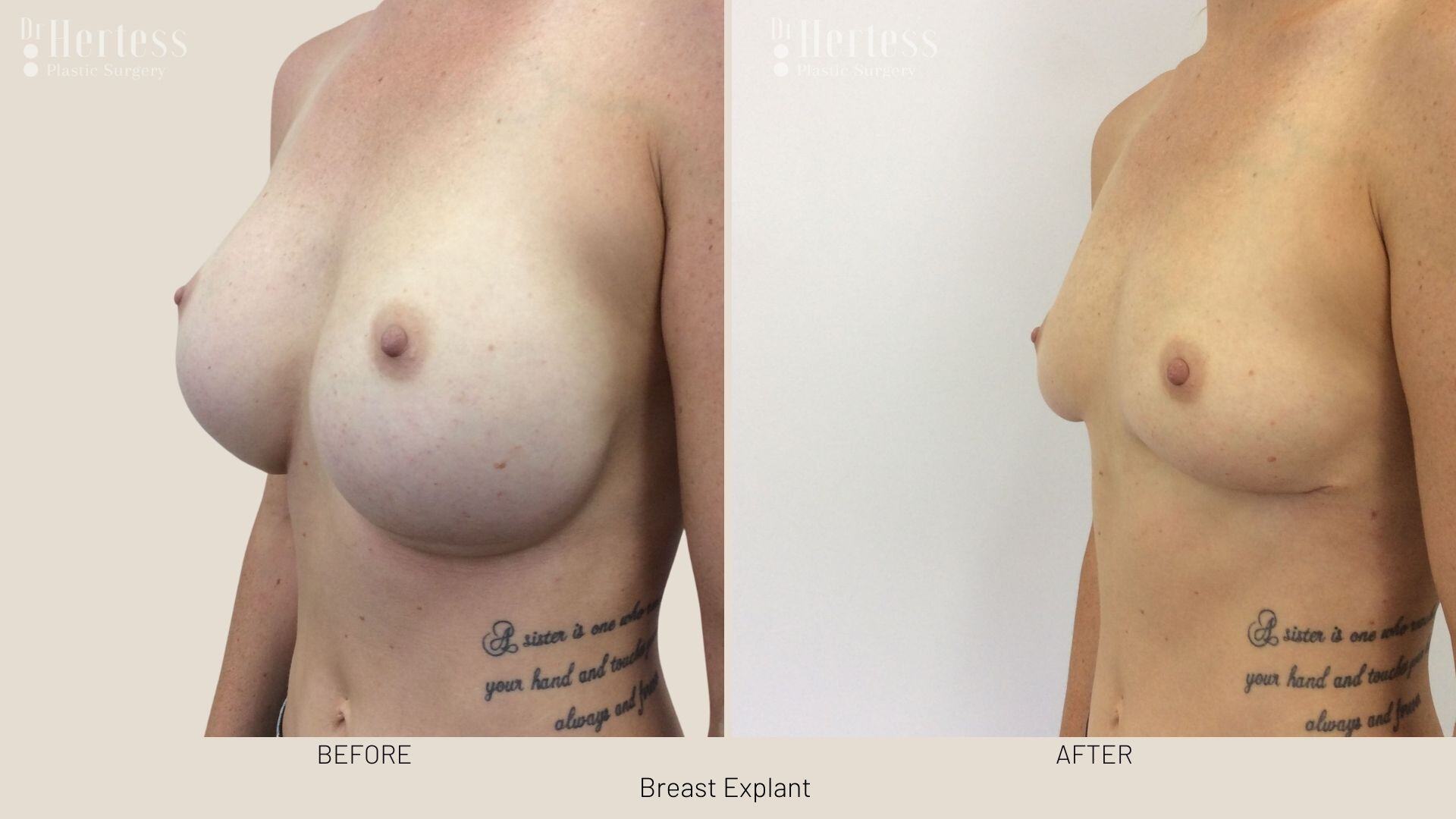 breast implant removal photos