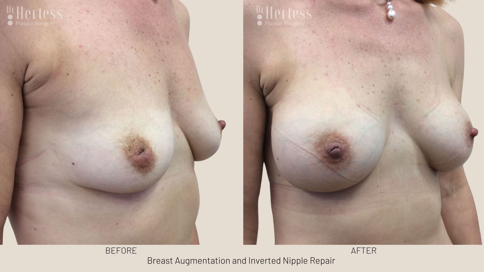 inverted nipple correction