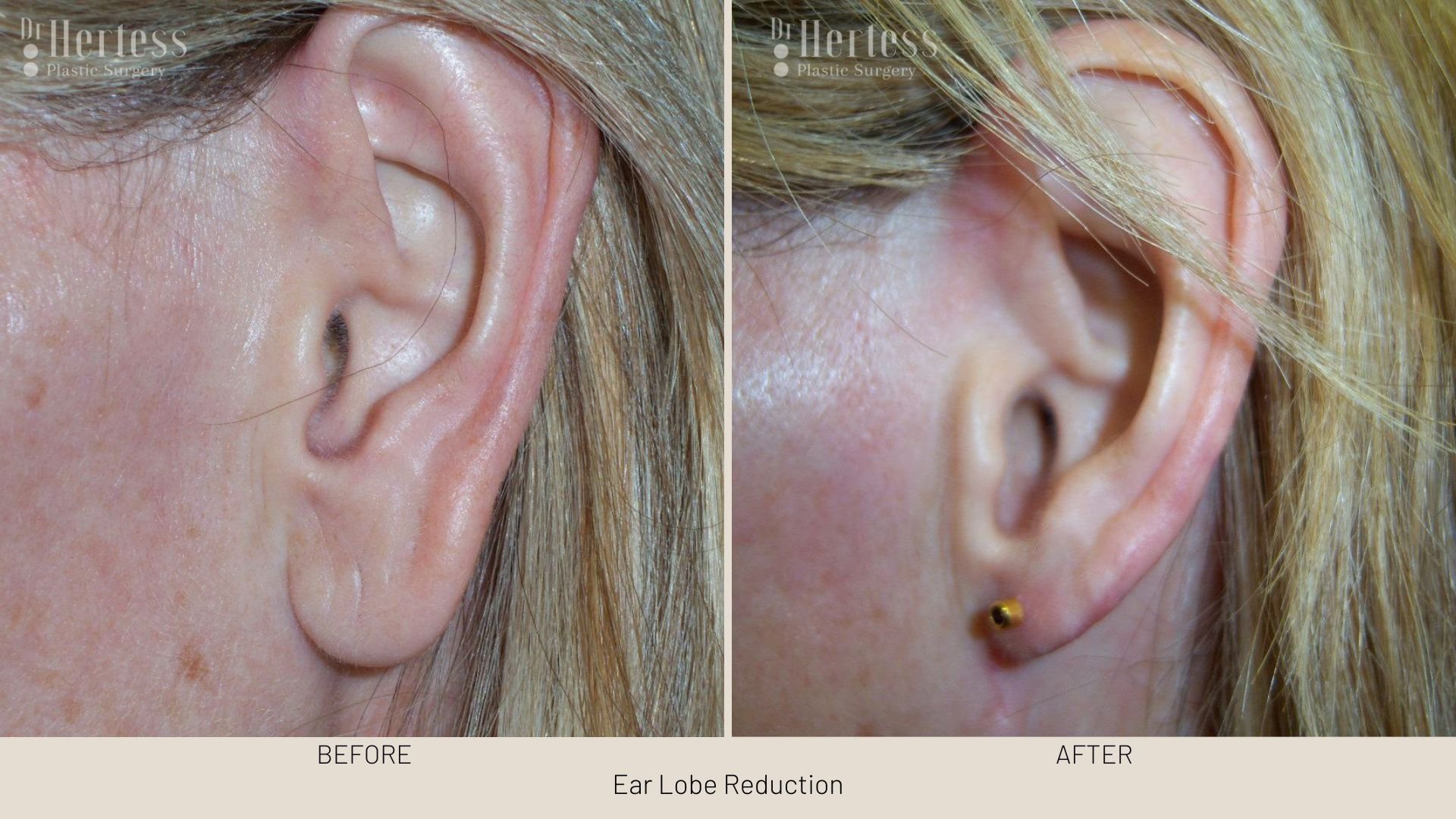 earlobe surgery