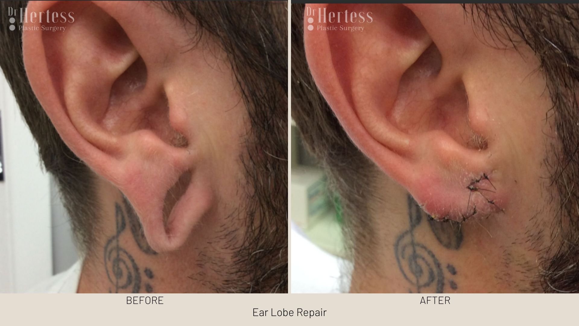 earlobe surgery